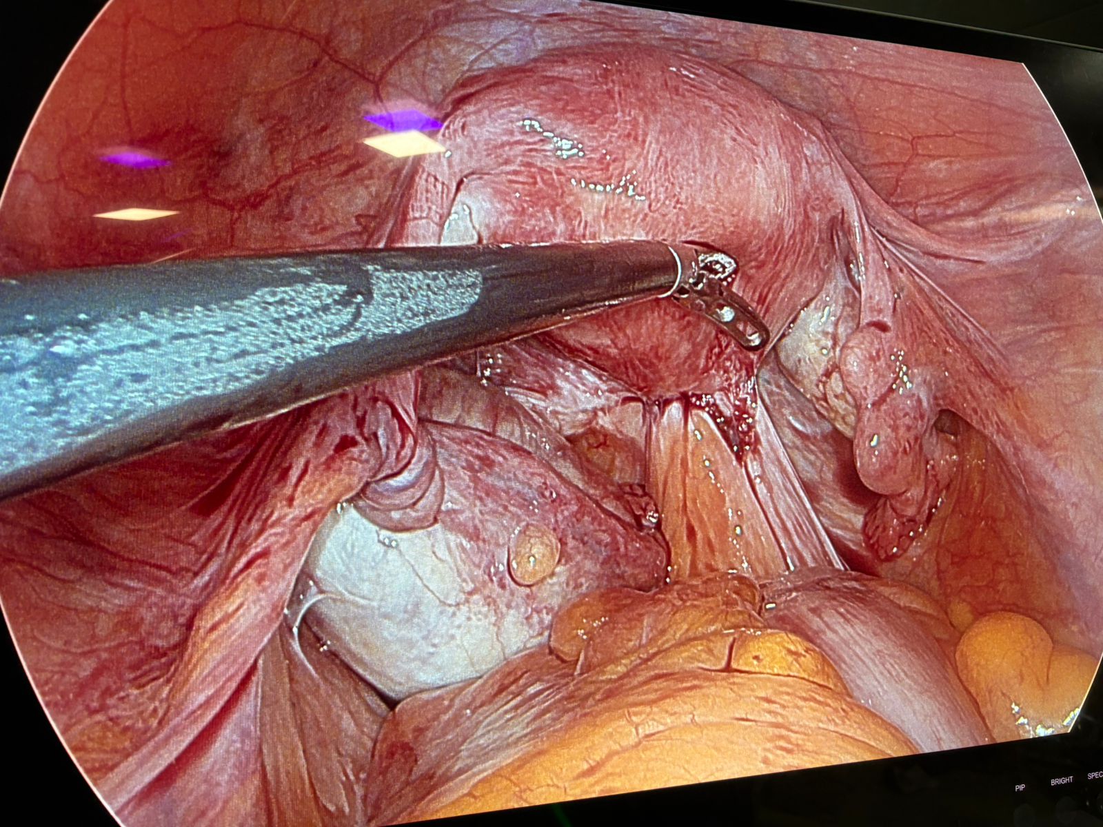 Dr. Mariam Anjum — Rectum Pulled-Up Adhesions